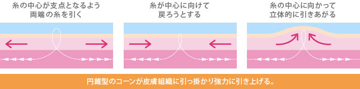 シルエットソフトリフト リフトアップの施術 銀座の美容整形外科 美容皮膚科ならノエル銀座クリニック