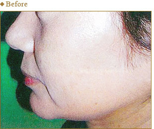 マイクロボトックスリフト リフトアップの施術 銀座の美容整形外科 美容皮膚科ならノエル銀座クリニック 公式